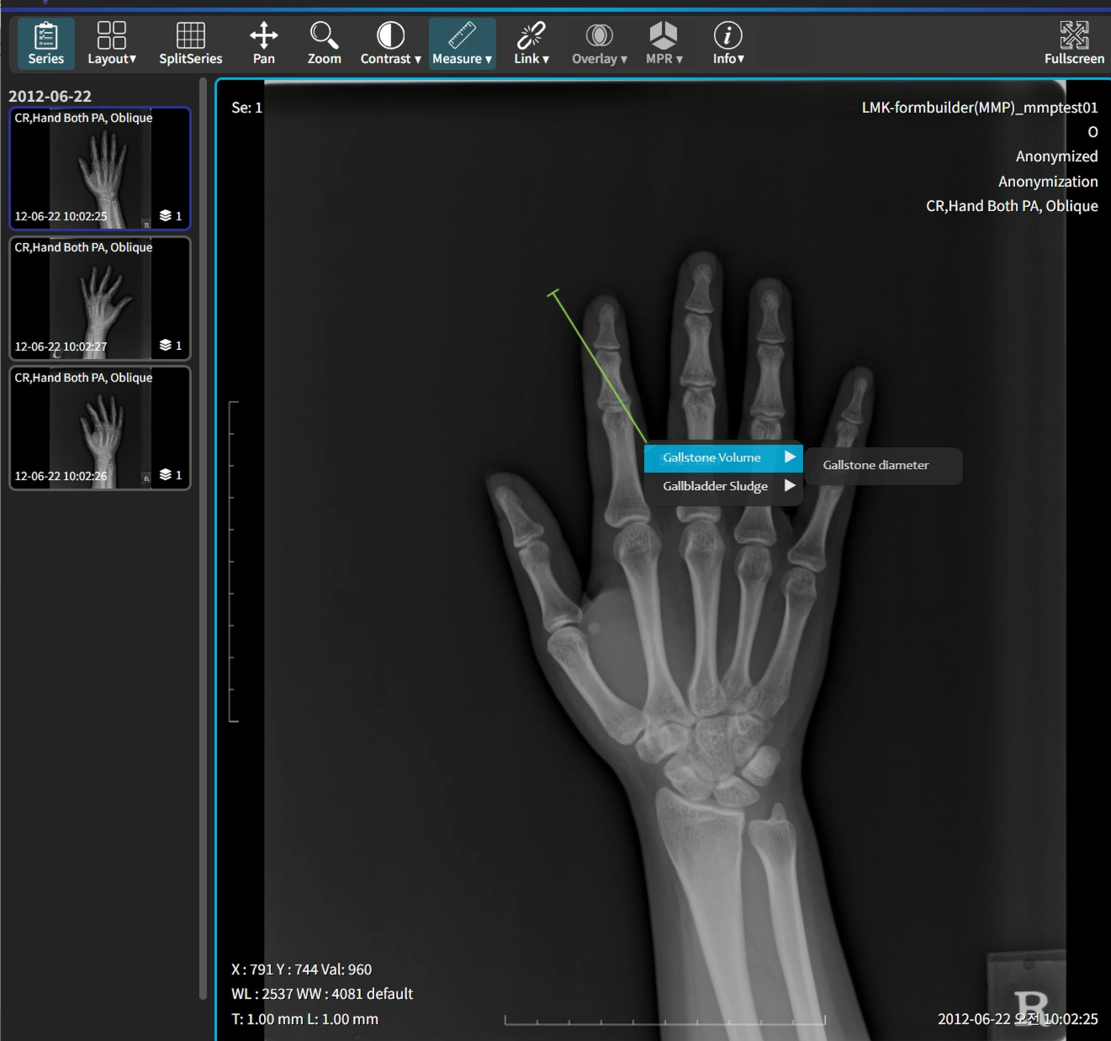 DICOM 뷰어에서 손 X-ray 영상을 측정 도구와 함께 판독하는 화면